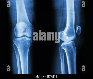 Film x-ray knee AP/lateral : show normal human's knee Stock Photo