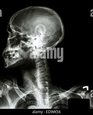 X-ray asian skull(thai people),cervical spine,both shoulder and blank area at right side Stock Photo