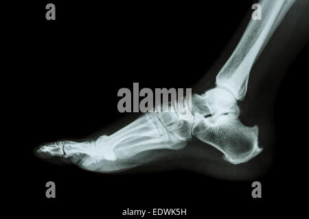 X-ray normal foot lateral Stock Photo