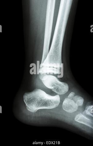 normal ankle xray