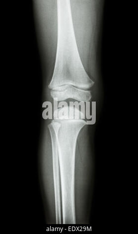 film x-ray knee AP(antero-posterior) of child Stock Photo