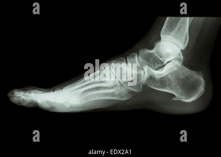 X-ray normal human's foot lateral Stock Photo