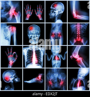 Collection X-ray multiple part of human and Arthritis,multiple disease (Gout , Rheumatoid,congenital heart disease,stroke) Stock Photo