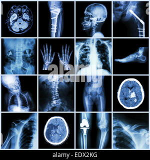 Set of X-ray multiple part of human,Multiple disease,orthopedic,surgery (Stroke,Bone fracture,Orthopedic operation,Kidney stone, Stock Photo