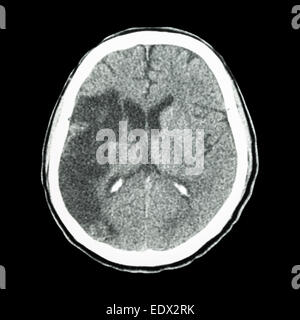 CT brain : show Ischemic stroke (hypodensity at right frontal-parietal lobe) Stock Photo