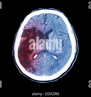 CT brain : show Ischemic stroke (hypodensity at right frontal-parietal lobe) Stock Photo