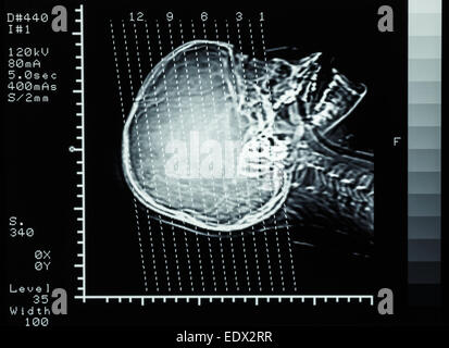 film CT scan (Computed tomography) brain : show section line on skull Stock Photo