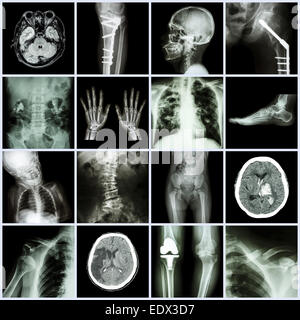 Set of X-ray multiple part of human,Multiple disease,orthopedic,surgery (Stroke,Bone fracture,Orthopedic operation,Kidney stone, Stock Photo