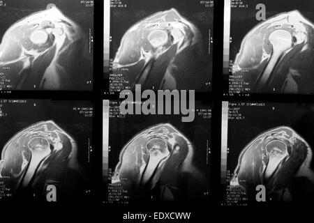 Magnetic Resonance Imaging or MRI of Shoulder Joint Coronal T2 FS and ...