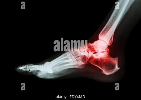 Arthritis at ankle joint (Gout , Rheumatoid arthritis) Stock Photo