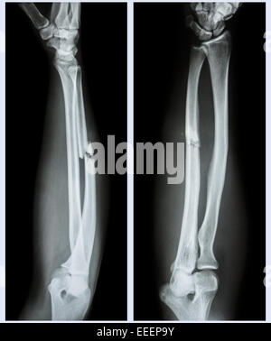 wrist X-ray of comminuted fracture of radius Stock Photo - Alamy