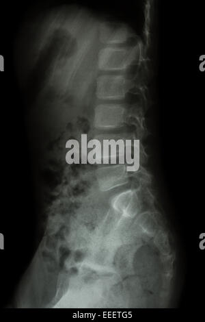 X-ray Of The Pelvis And Spinal Column. Stock Photo, Picture and