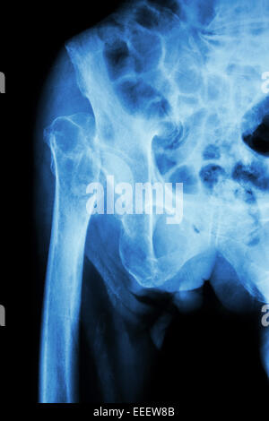 X-ray pelvis & hip joint  : Fracture head of femur (thigh bone) Stock Photo