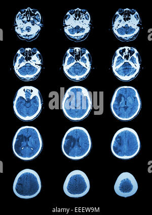 CT scan (computed tomography) of brain show cerebral infarction at right temporal-parietal lobe  ( ischemic stroke ) Stock Photo