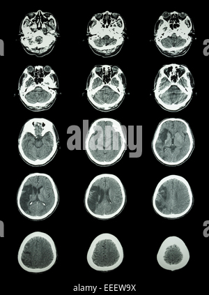 CT scan (computed tomography) of brain show cerebral infarction at right temporal-parietal lobe  ( ischemic stroke ) Stock Photo