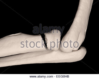 does radial head fracture cause wrist pain