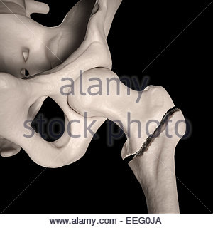 OSTEOPOROSIS, ILLUSTRATION Stock Photo - Alamy