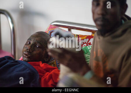 Political victim Masum age of 15 a bus helper suffer burns in Dhaka Medical College Hospital (DMCH) as pickets set fire to a bus during BNP-led 20-party's countrywide blockade. According to local reports at least 23 people have been killed and 18 victims have been admitted to the burn unit in deliberately set fires, acts of sabotage, and torching of vehicles during the 14th day of the Bangladesh Nationalist Party (BNP) led 20-party's indefinite blokade of roads, railways and waterways as a protest after the Bangladeshi government detainment of BNP leader and former prime minister Khaleda Zia Stock Photo