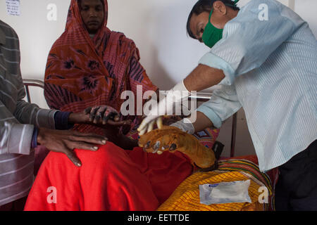 Dhaka, Bangladesh. 21st January, 2015. Masum 15 suffering burn injuries from an attack on a bus during a nationwide strike called by the Bangladesh Nationalist Party (BNP)-led alliance, recuperates at Dhaka Medical College Hospital (DMCH). Credit:  zakir hossain chowdhury zakir/Alamy Live News Stock Photo