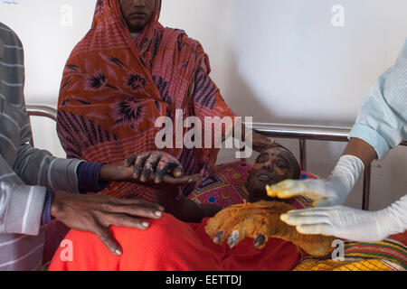 Dhaka, Bangladesh. 21st January, 2015. Masum 15 suffering burn injuries from an attack on a bus during a nationwide strike called by the Bangladesh Nationalist Party (BNP)-led alliance, recuperates at Dhaka Medical College Hospital (DMCH). Credit:  zakir hossain chowdhury zakir/Alamy Live News Stock Photo