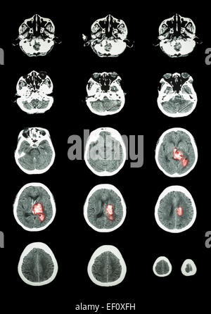 Hemorrhagic Stroke . CT scan (computed tomography) of brain ...