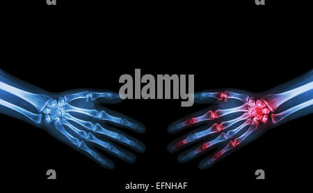 X-ray normal person is shaking hand with Arthritis hand person Stock Photo