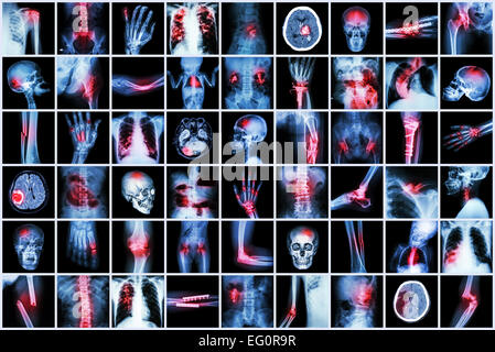 X-ray multiple disease of child and adult ( Stroke , Arthritis , Fracture , Tuberculosis , Brain tumor , Bowel obstruction  , Ki Stock Photo