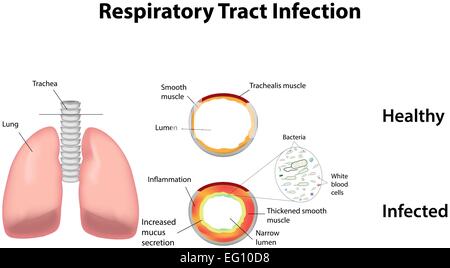 Respiratory Tract Infection Stock Vector