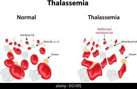 Thalassemia Stock Vector
