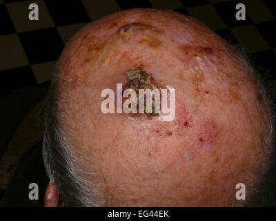 Squamous-cell carcinoma of the scalp Stock Photo