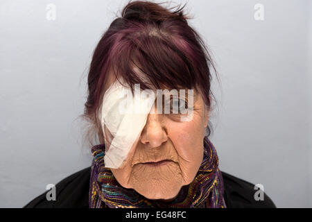 Woman wearing bandage over her eye after having a cataract removal operation Stock Photo
