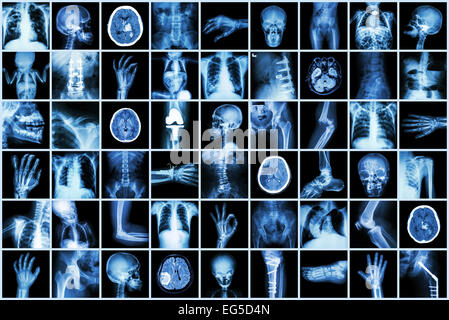 Pulmonary Tuberculosis ( Chest X-ray of child : show patchy ...