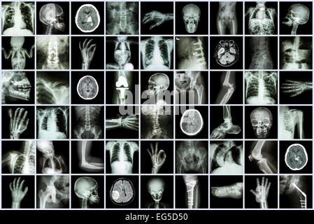 X-ray multiple part of adult and child and Disease ( Pulmonary tuberculosis Stroke kidney stone osteoarthritis bone fracture bow Stock Photo
