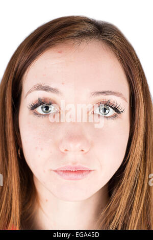 woman face pimple isolated on white background Stock Photo