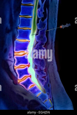 Contrast solution, lumbar vertebrae, myelography, herniated disc, illustration Stock Photo