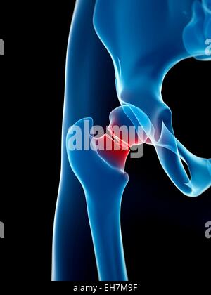 medical illustration of broken hip Stock Photo: 144567316 - Alamy