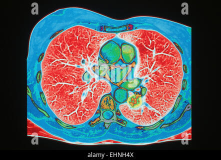 Coloured CTscan of the upper chest showing a tumor in the lungs ( in green). Stock Photo