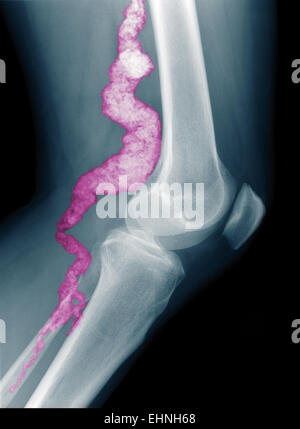 A knee x-ray of a patient with ACDC, a rare calcification disorder, reveals calcification in the main artery supplying blood to the lower leg. Stock Photo