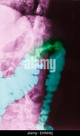 Color enhanced x-ray of a patient with colon cancer. Stock Photo