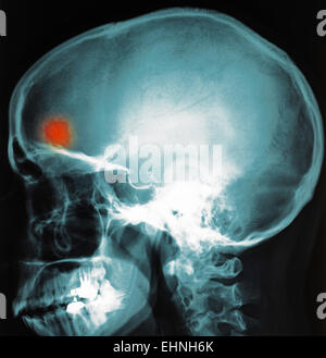 X-ray of brain abscess. Stock Photo