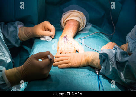 Carpal tunnel syndrome surgery. Stock Photo