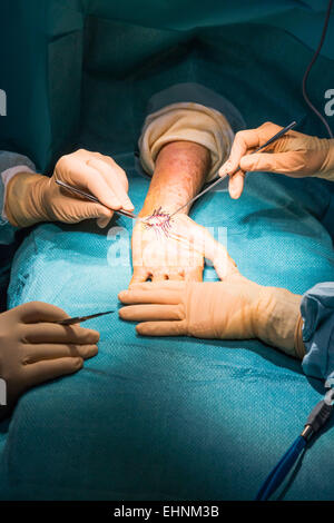 Carpal tunnel syndrome surgery. Stock Photo