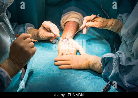 Carpal tunnel syndrome surgery. Stock Photo