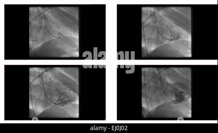 Angiogram sequence working clockwise using x-rays with a contrast agent injected from a tube inserted into the arteries (left & c Stock Photo