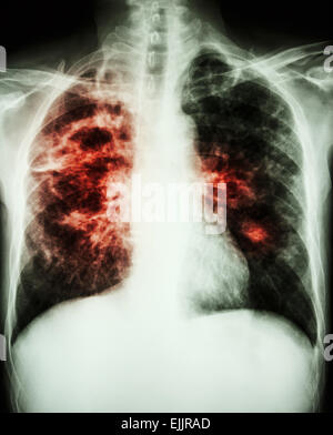 film chest x-ray show cavity at right lung,fibrosis & interstitial & patchy infiltrate at both lung due to Mycobacterium tubercu Stock Photo