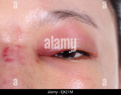 close-up of upper eye lid swell after nose job plastic surgery Stock Photo