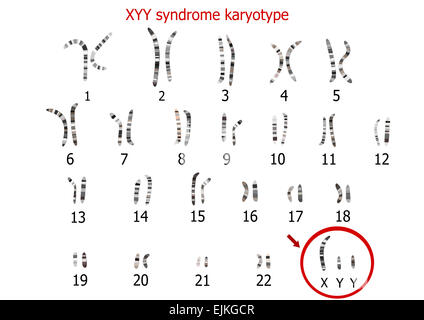 XYY syndrome (supermale) karyotype Stock Photo