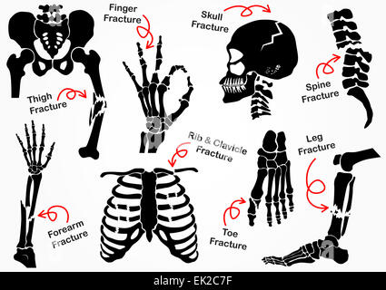 Set Bone Fracture Icon ( Pelvic , Hip , Thigh ( femur ) , Hand , Wrist , Finger , Skull , Face , Vertebra , Arm , Elbow , Thorax Stock Photo
