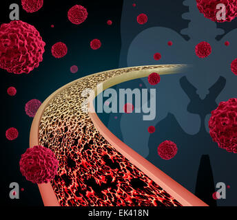 Bone cancer concept illustration as a close up diagram of the inside of a human bone from a skeletal hip joint as a normal healthy medical condition gradually degrades to abnormal unhealthy anatomy with malignant tumor cells. Stock Photo