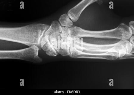 X-Ray Of Carpal And Metacarpal Bones In The Human Hand Stock Photo